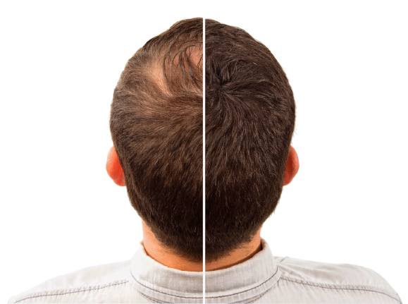Hair Intense - controindicazioni - effetti collaterali